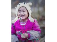  Little Bareheaded Ichthyosis Girl----Mermaid Angel,Yuan