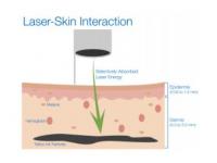 How Laser Tattoo Removal Works