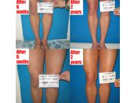 Will there has recurrence after ichthyosis treatment?