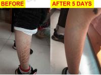 Can Zhangjian Therapy cure ichthyosis permanently?