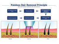 Professional 3 Wavelengths 808Nm Diode Laser Hair Removal Machine