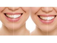 WHY DO CONSUMERS PREFER WHITENING STRIPS OVER TEETH WHITENING TREATMENT