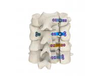 Types of Cervical Spine Implants and Their Applications