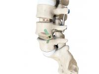 How Do Spinal Fusion Implants Improve Postoperative Stability?