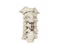 Titanium vs. PEEK Spinal Fusion Implants: Which Is Better for Your Case?